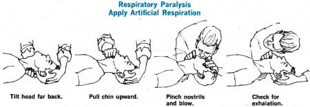 Respiratory Paralysis, Apply Artificial Respiration - RF Cafe